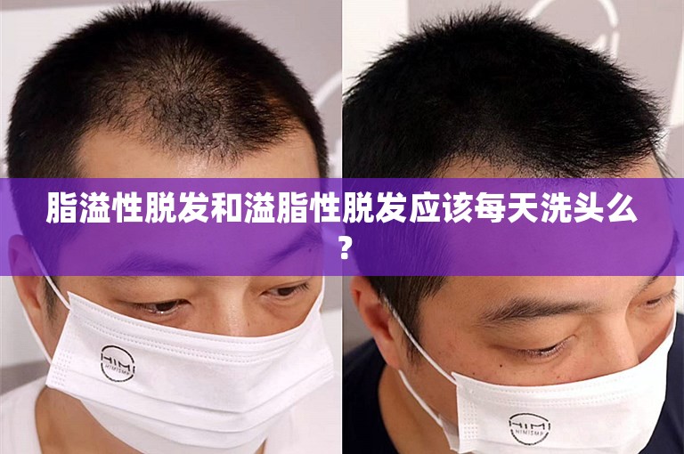 脂溢性脱发和溢脂性脱发应该每天洗头么？