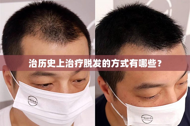 治历史上治疗脱发的方式有哪些？
