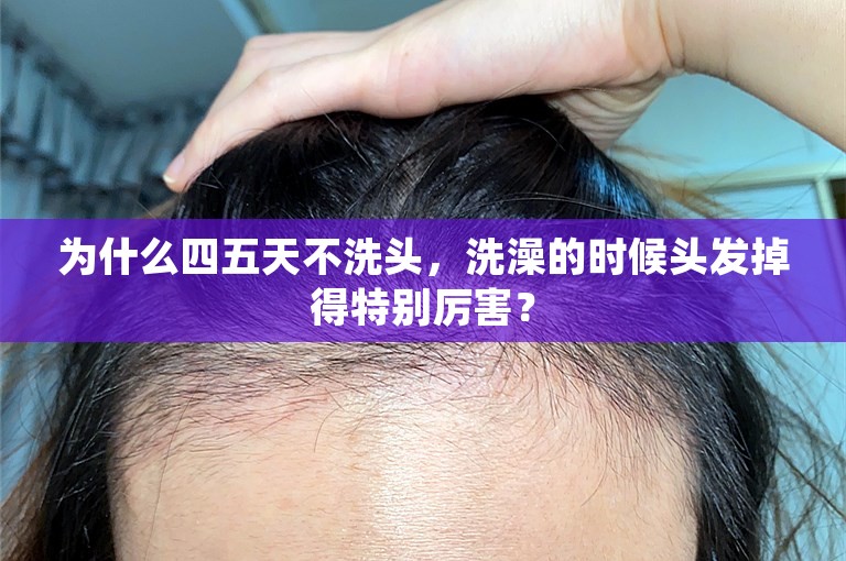 为什么四五天不洗头，洗澡的时候头发掉得特别厉害？