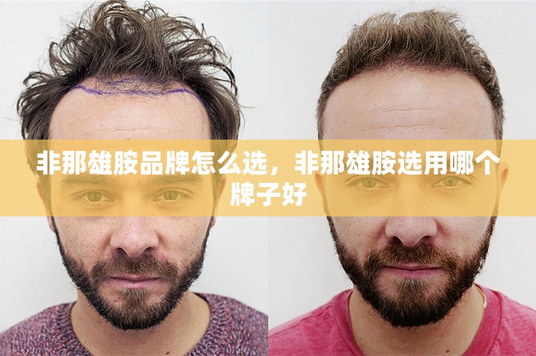 非那雄胺品牌怎么选，非那雄胺选用哪个牌子好
