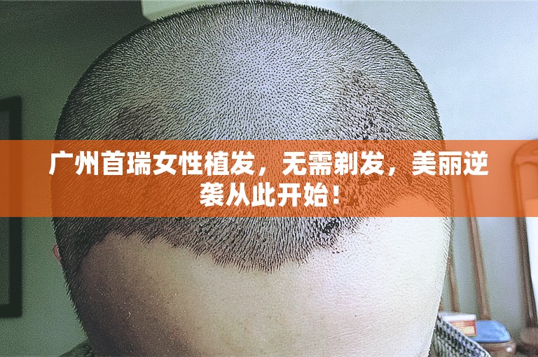 广州首瑞女性植发，无需剃发，美丽逆袭从此开始！