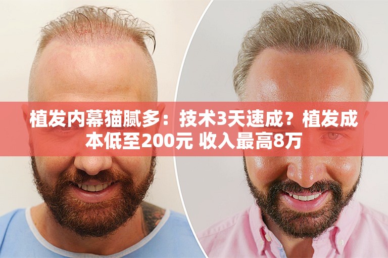 植发内幕猫腻多：技术3天速成？植发成本低至200元 收入最高8万