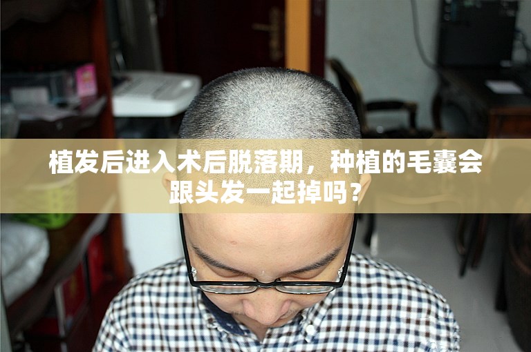 植发后进入术后脱落期，种植的毛囊会跟头发一起掉吗？