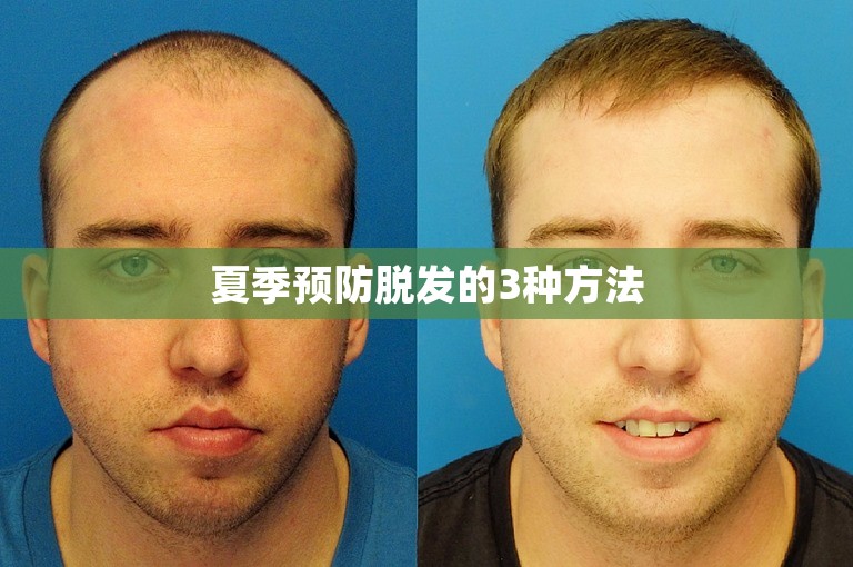 夏季预防脱发的3种方法