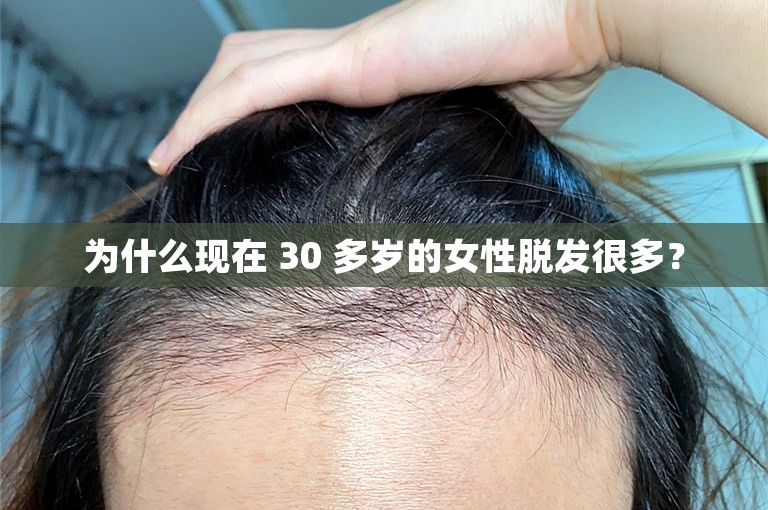 为什么现在 30 多岁的女性脱发很多？