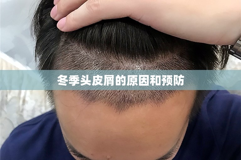 冬季头皮屑的原因和预防
