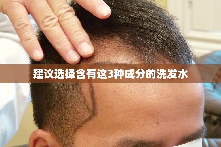 建议选择含有这3种成分的洗发水