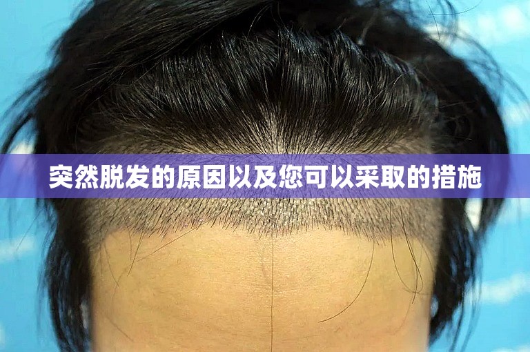 突然脱发的原因以及您可以采取的措施