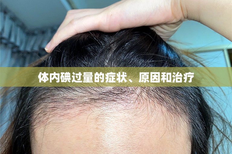 体内碘过量的症状、原因和治疗 体内碘过量的症状、原因和治疗