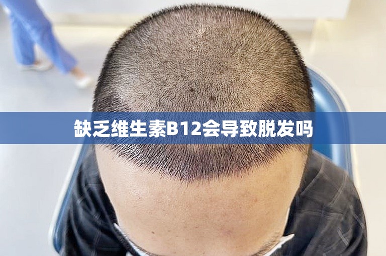 缺乏维生素B12会导致脱发吗