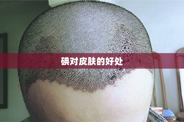 碘对皮肤的好处 碘对皮肤的好处