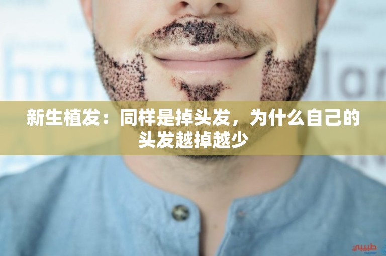 新生植发:同样是掉头发,为什么自己的头发越掉越少 新生植发:同样是掉头发,为什么自己的头发越掉越少