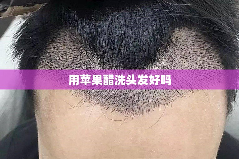 用苹果醋洗头发好吗
