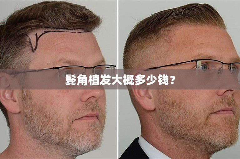 鬓角植发大概多少钱？