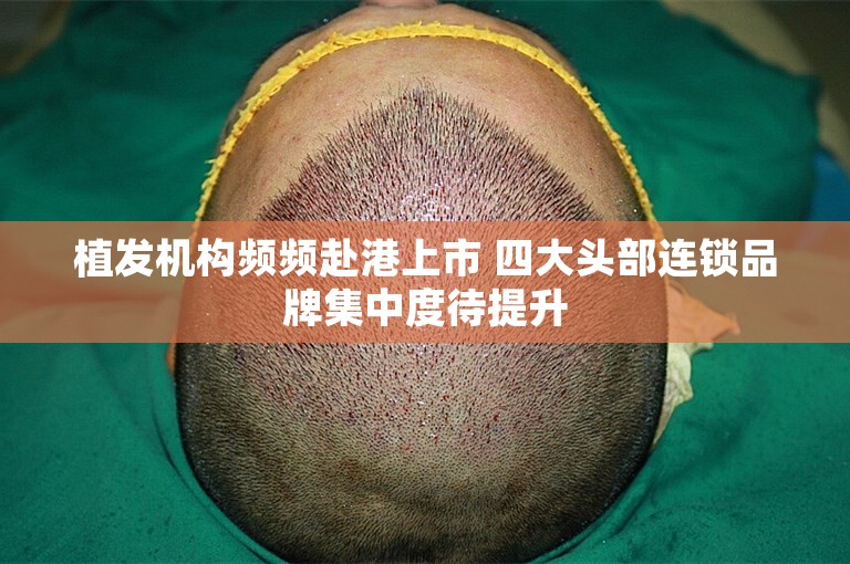 植发机构频频赴港上市 四大头部连锁品牌集中度待提升