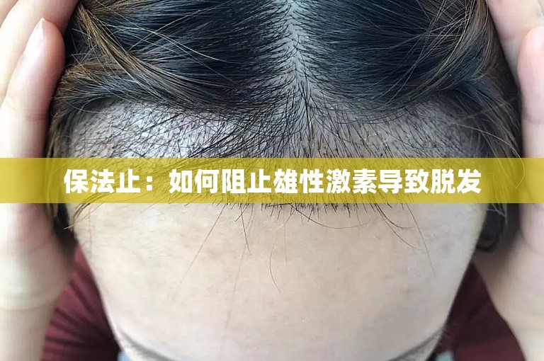 保法止：如何阻止雄性激素导致脱发