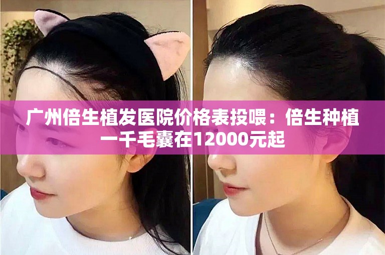 广州倍生植发医院价格表投喂：倍生种植一千毛囊在12000元起