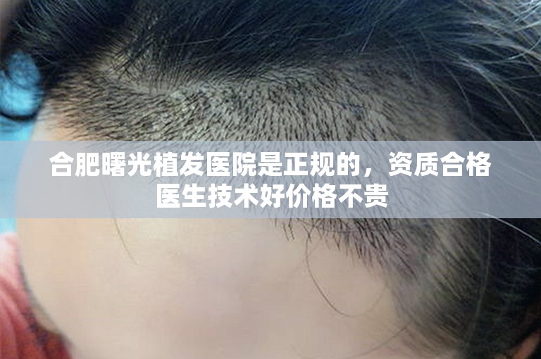合肥曙光植发医院是正规的，资质合格医生技术好价格不贵