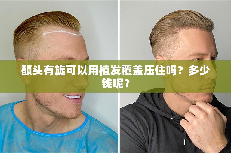 额头有旋可以用植发覆盖压住吗?多少钱呢? 额头有旋可以用植发覆盖压住吗?多少钱呢?