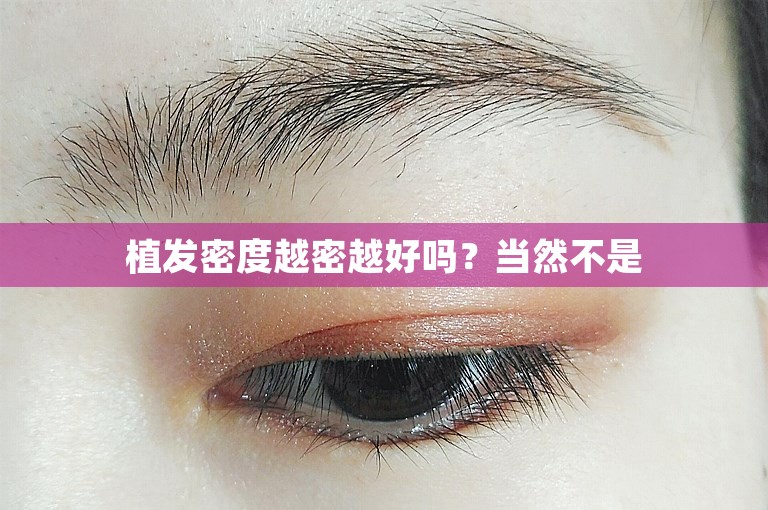植发密度越密越好吗？当然不是