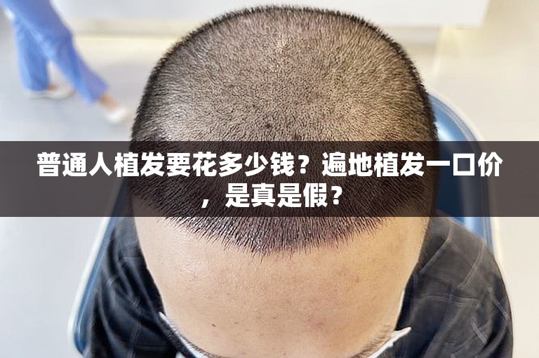 普通人植发要花多少钱?遍地植发一口价,是真是假? 普通人植发要花多少钱?遍地植发一口价,是真是假?