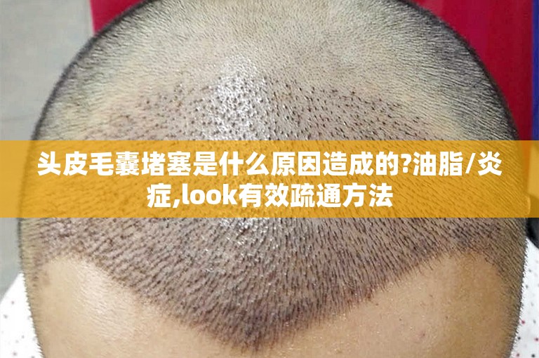 头皮毛囊堵塞是什么原因造成的?油脂/炎症,look有效疏通方法 头皮毛囊堵塞是什么原因造成的?油脂/炎症,look有效疏通方法