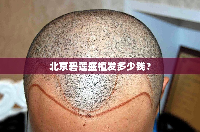 北京碧莲盛植发多少钱？