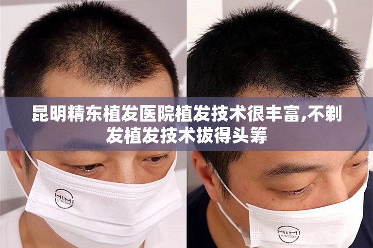 昆明精东植发医院植发技术很丰富,不剃发植发技术拔得头筹