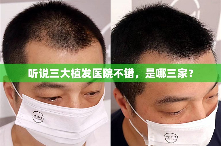 听说三大植发医院不错,是哪三家? 听说三大植发医院不错,是哪三家?
