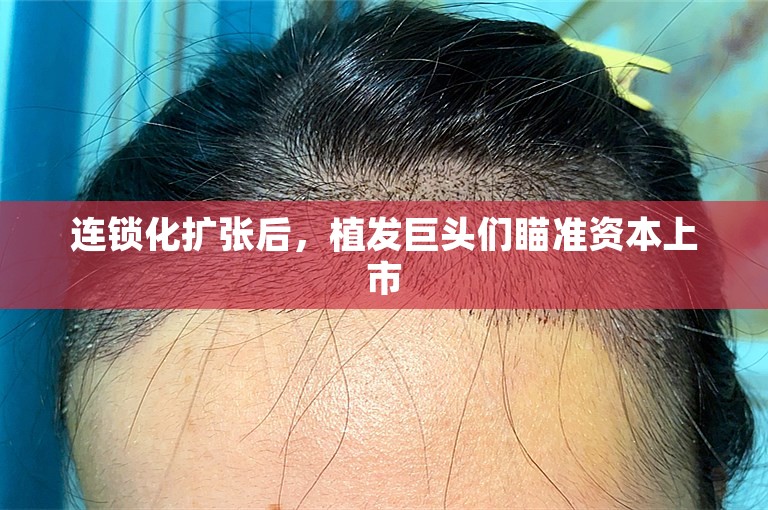 连锁化扩张后,植发巨头们瞄准资本上市 连锁化扩张后,植发巨头们瞄准资本上市