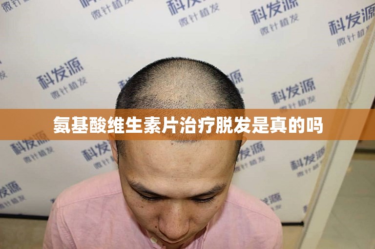 氨基酸维生素片治疗脱发是真的吗
