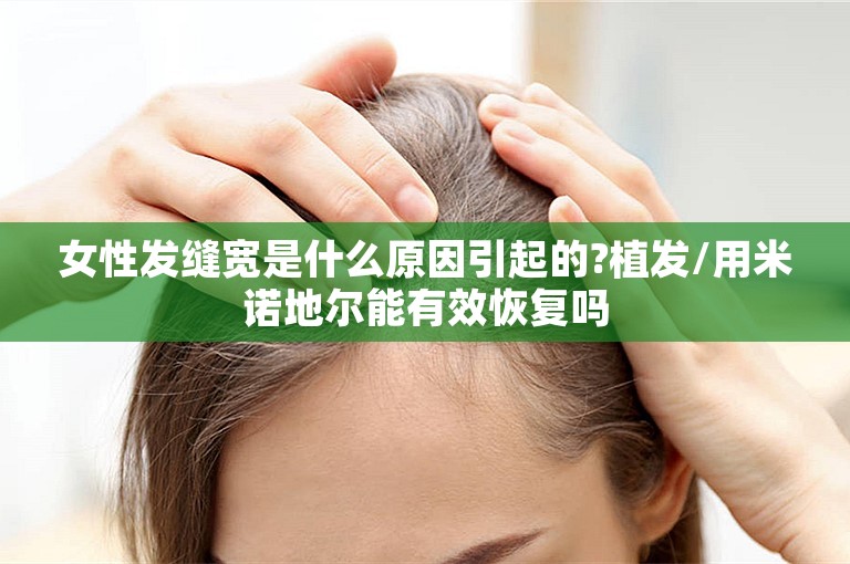女性发缝宽是什么原因引起的?植发/用米诺地尔能有效恢复吗