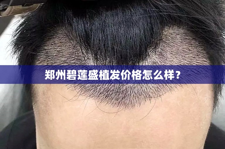 郑州碧莲盛植发价格怎么样？