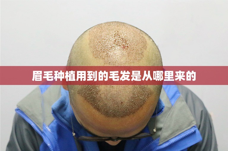 眉毛种植用到的毛发是从哪里来的