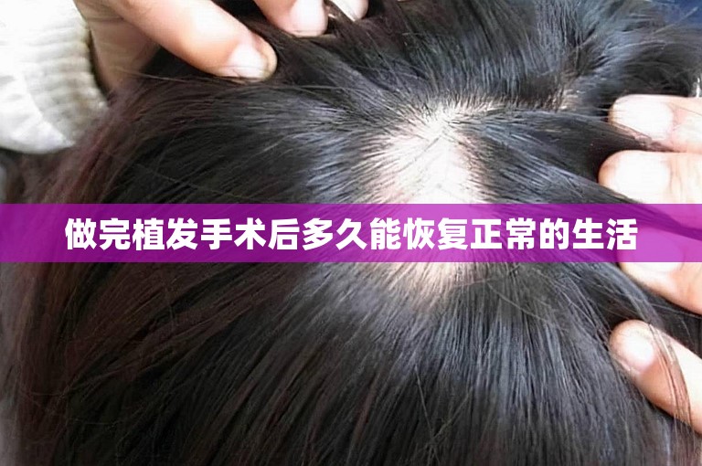做完植发手术后多久能恢复正常的生活