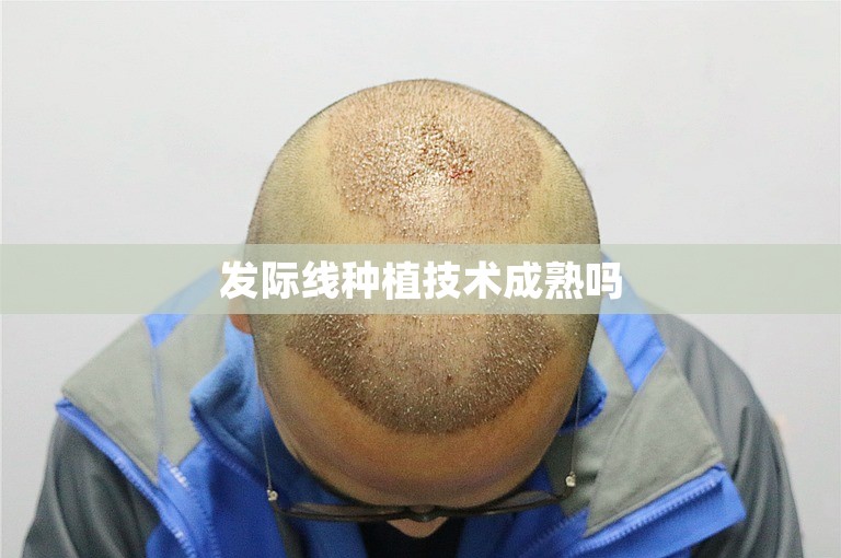 发际线种植技术成熟吗