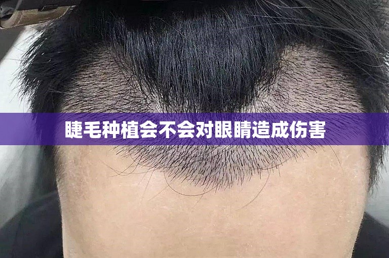 睫毛种植会不会对眼睛造成伤害
