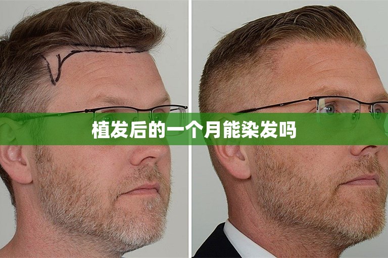 植发后的一个月能染发吗