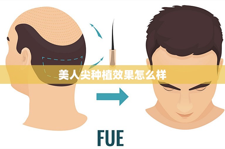 美人尖种植效果怎么样
