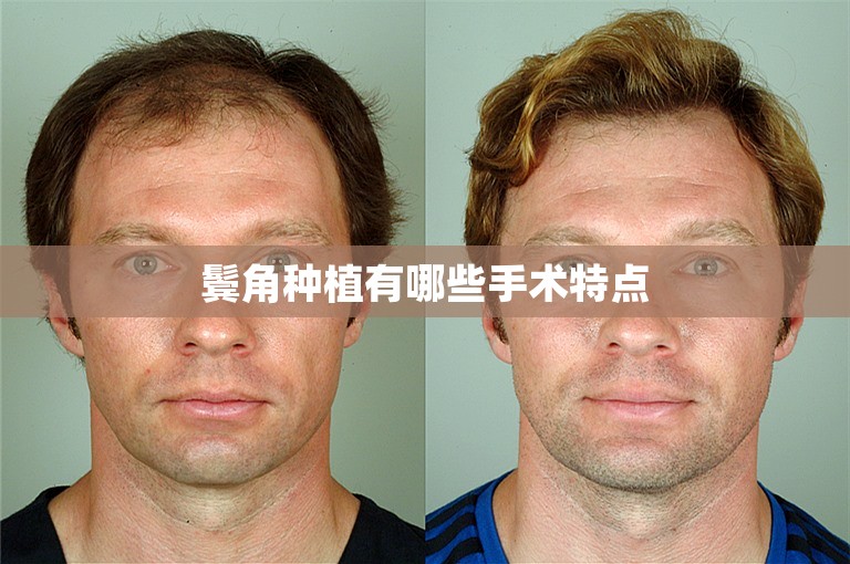 鬓角种植有哪些手术特点
