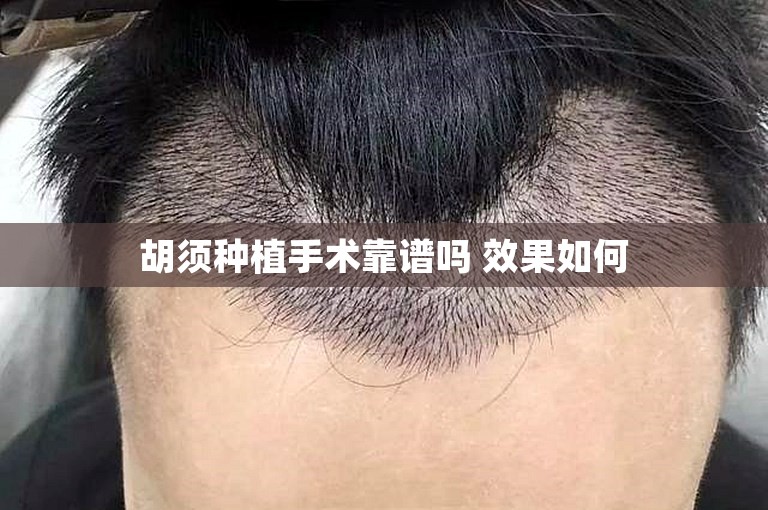 胡须种植手术靠谱吗 效果如何
