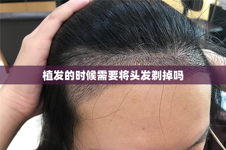 植发的时候需要将头发剃掉吗