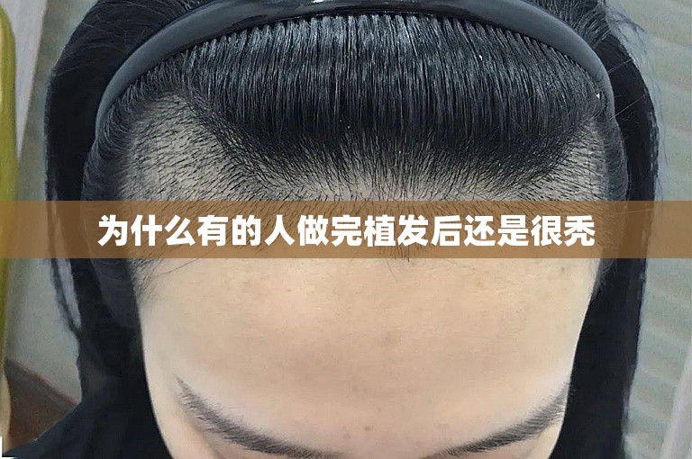 为什么有的人做完植发后还是很秃