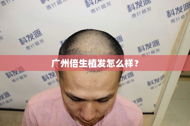 广州倍生植发怎么样? 广州倍生植发怎么样?