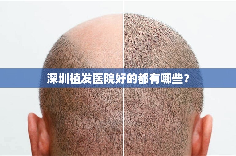 深圳植发医院好的都有哪些？