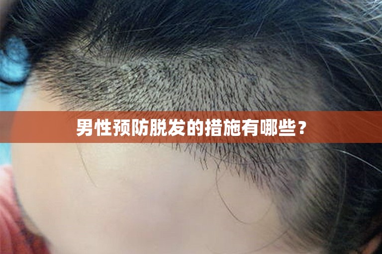 男性预防脱发的措施有哪些？