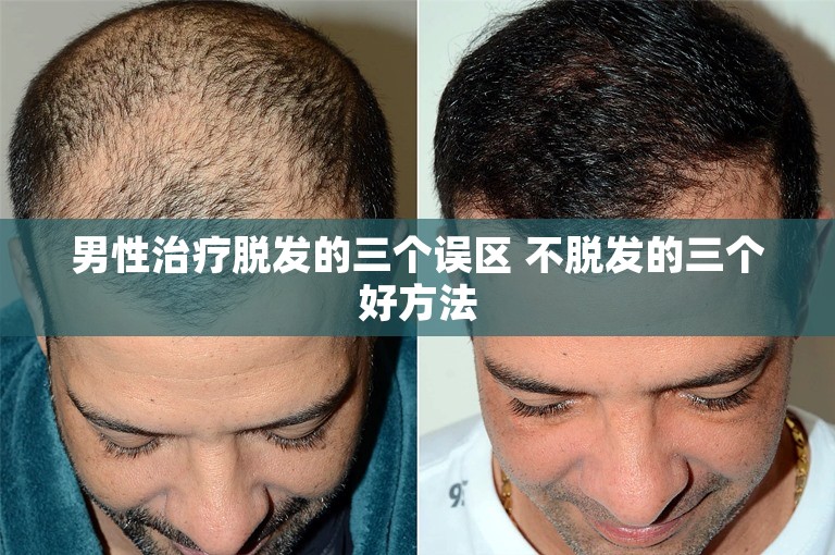 男性治疗脱发的三个误区 不脱发的三个好方法
