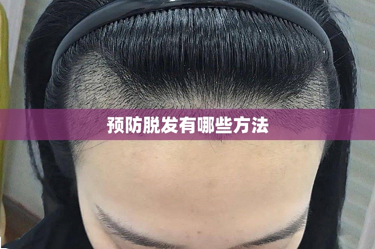 预防脱发有哪些方法 预防脱发有哪些方法