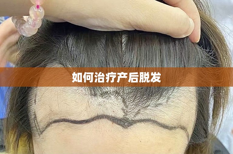 如何治疗产后脱发