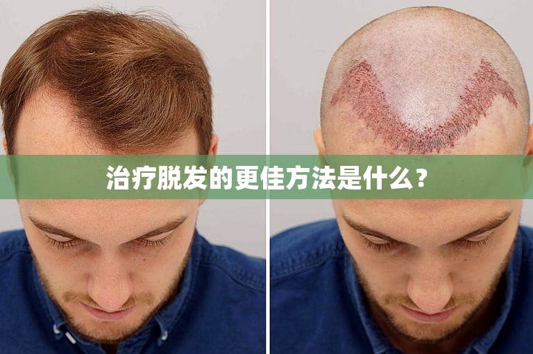 治疗脱发的更佳方法是什么? 治疗脱发的更佳方法是什么?